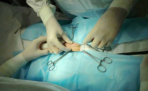 La chirurgie de l'organe reproducteur contribuera à augmenter sa taille.